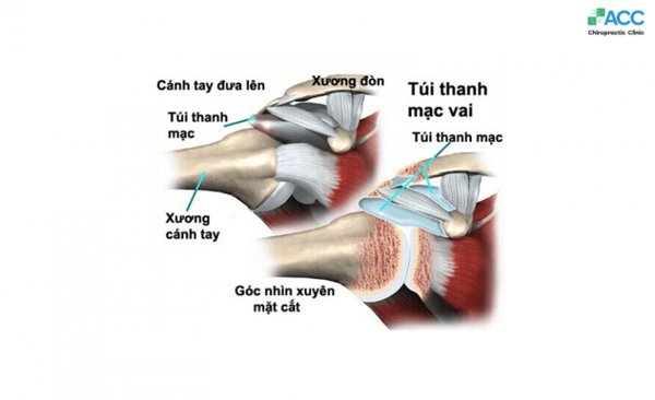 nguyên nhân đau vai