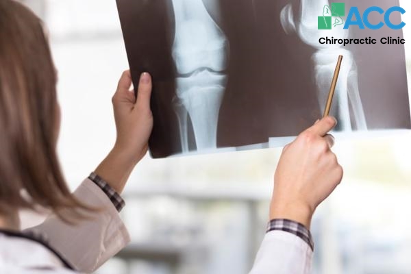 cách chữa căng cơ đầu gối