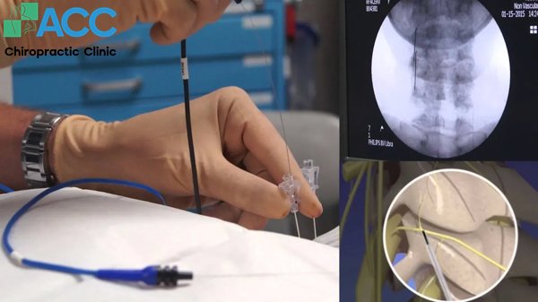 chữa thoát vị đĩa đệm bằng sóng cao tần