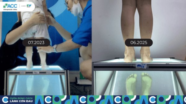 bàn chân bẹt mức độ 3