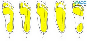 các mức độ bàn chân bẹt