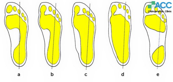 các mức độ bàn chân bẹt