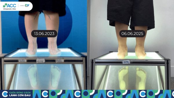 mức độ bàn chân bẹt là gì