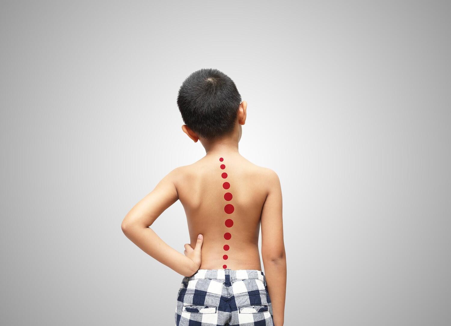 Tìm hiểu tật cong vẹo cột sống do nguyên nhân chủ yếu nào