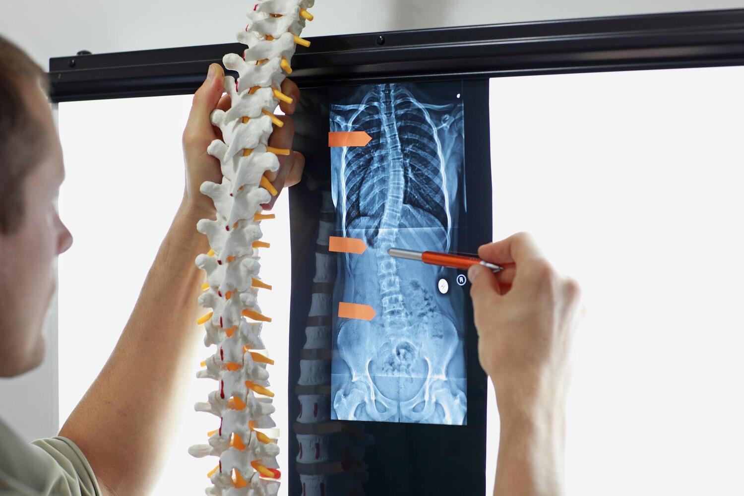 Làm sao để chẩn đoán tình trạng cong vẹo xương cột sống