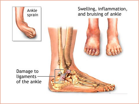 ACC English | Ankle pain - ACC