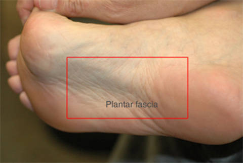 plantar fascia problems